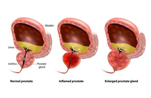 la prostatite è un'infiammazione della ghiandola prostatica