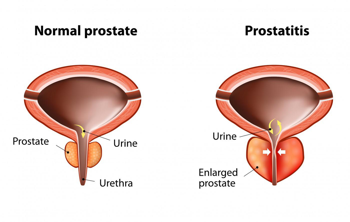 Prostata normale di un uomo sano e infiammazione della ghiandola prostatica con prostatite